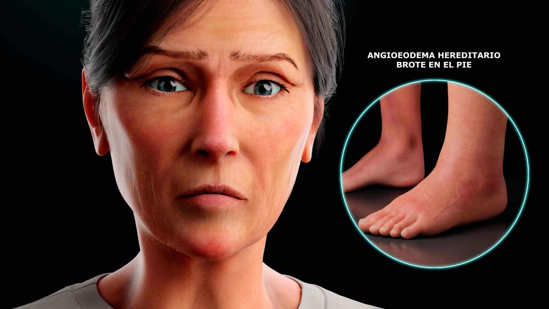 Evidenze and BioCryst hereditary angioedema 3D interactive experience