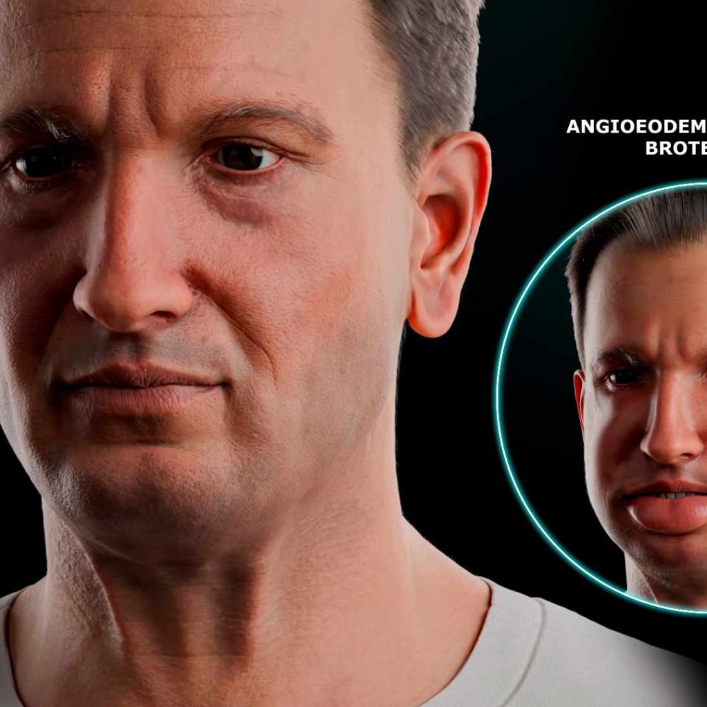 Evidenze hereditary angioedema 3D animation